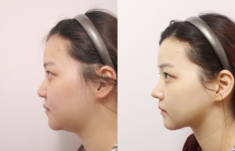 面部吸脂最好的辦法是什么？做一次面部吸脂多少錢(qián)？