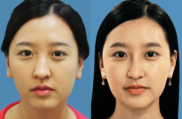 面部不對稱可以怎么矯正？臉一邊大一邊小怎么矯正？