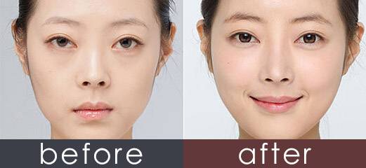 玻尿酸填充蘋果肌后效果能保持多久？想豐蘋果肌是自體好一點(diǎn)還是玻尿酸好一點(diǎn)？