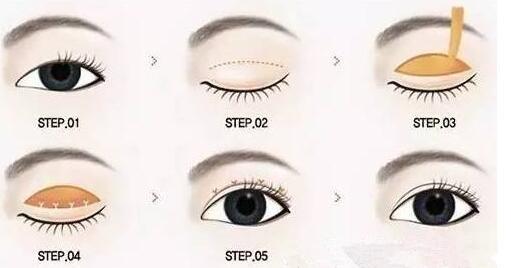 哈爾濱第一醫(yī)院切開雙眼皮多少錢？切開雙眼皮如何恢復(fù)？