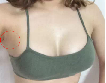 南京美貝爾醫(yī)療美容醫(yī)院做假體隆胸手術(shù)后的一個(gè)月