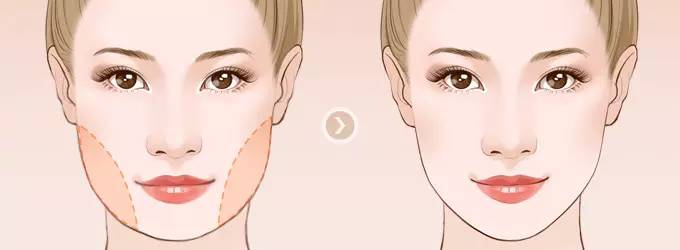 做下頜角整形手術(shù)效果好嗎？下頜角整形手術(shù)要多少錢？