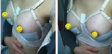 長沙愛思特醫(yī)療美容醫(yī)院做假體隆胸術(shù)后的第4天