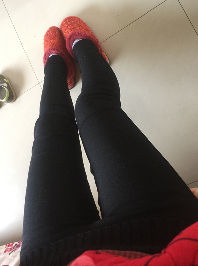 蘇州圣愛醫(yī)院醫(yī)療美容科做大腿吸脂手術(shù)后的日常