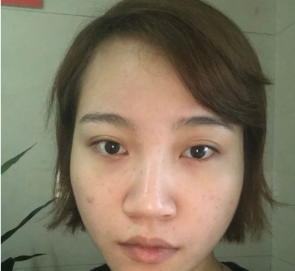 上海時光整形外科醫(yī)院做鼻綜合手術前